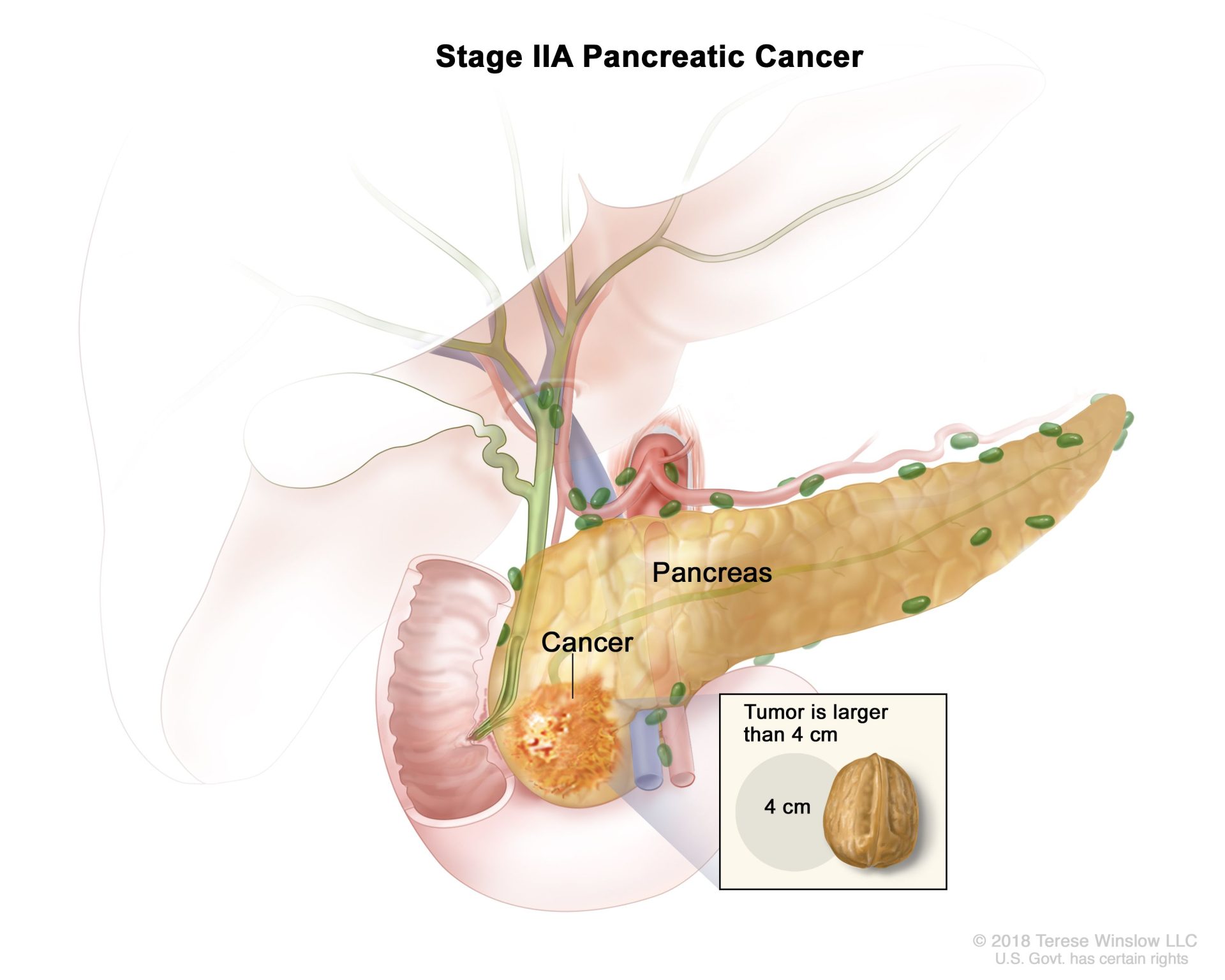Pancreatic neuroendocrine tumors
