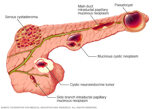 Pancreatic cysts