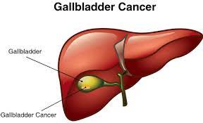 Gallbladder Stone Cancer
